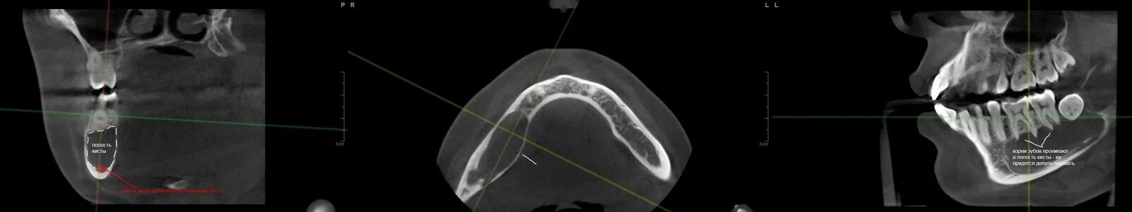 Радикулярная киста верхней челюсти кт. Фиброма верхней челюсти на кт. Как выглядит киста на кт. Киста носонебного канала на кт. Киста пазухи верхней челюсти кт.