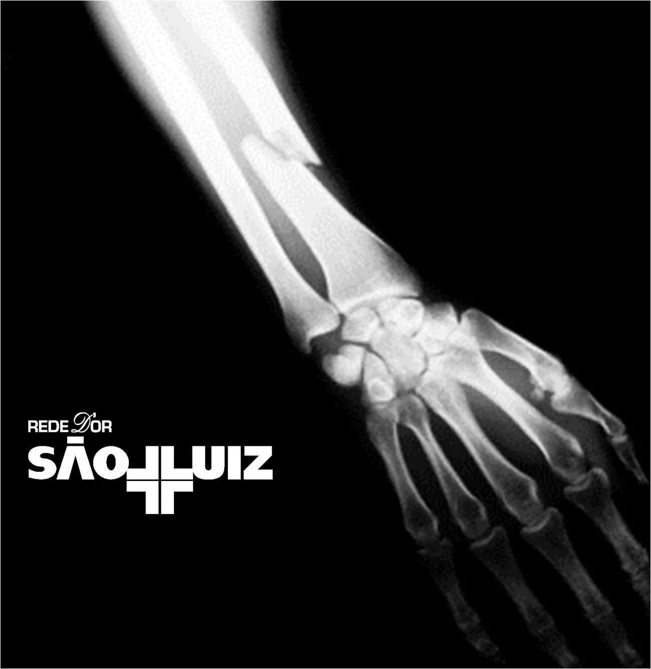 Рентгенограмма перелом кости. Break bone. Открытый перелом предплечья рентген. Break bone. Снимок руки.