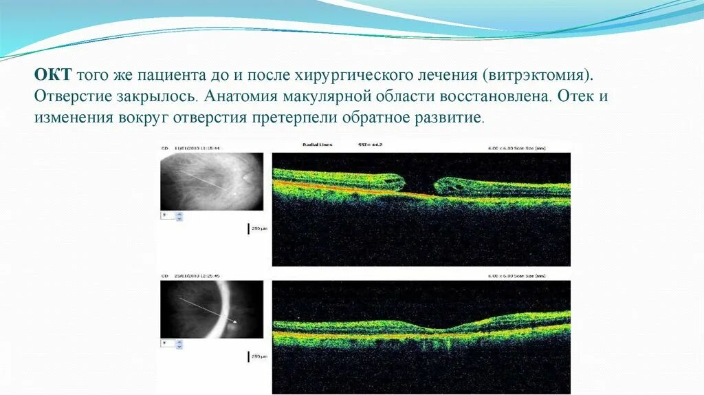 Макулярный отек лечение. Оптическая когерентная томография макулярной области. Диабетический макулярный отек окт. Ламеллярный макулярный разрыв окт. Макулярный отек классификация.