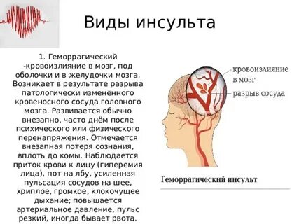 Внутреннее кровотечение головного мозга