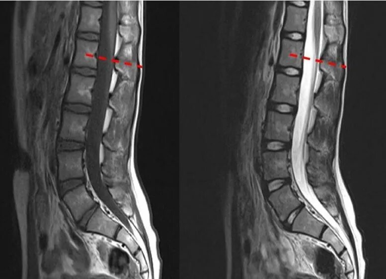 Гидромиелия спинного мозга мрт. Конус спинного мозга l1. Липома спинного мозга мрт. Спинальный инсульт мрт.