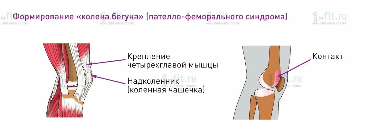 Синдром подвздошно большеберцового. Четырехглавая мышца коленная чашечка. синдром бегуна колено илиотибиального тракта. подвздошно-большеберцовый тракт боль. илиотибиальный тракт коленного сустава.