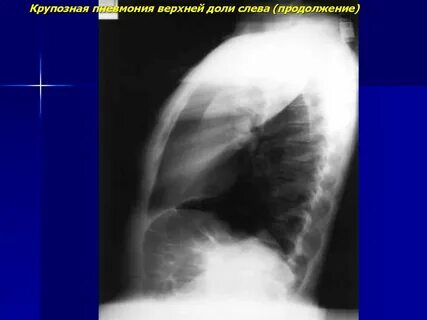 Пневмония в верхней доле левого легкого