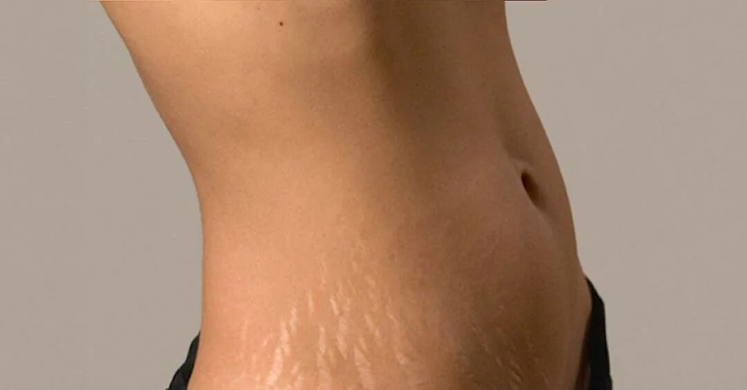 Растяжки stretch marks. Растяжки stretch marks