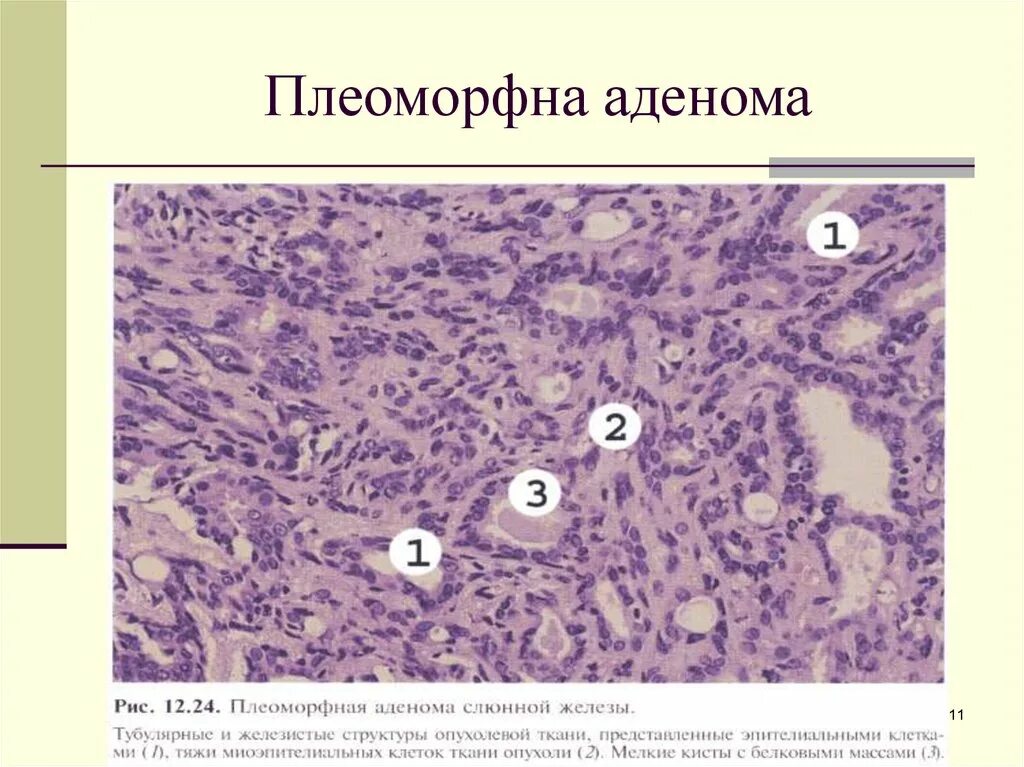 Смешанная опухоль слюнной железы препарат. Аденома слюнной железы гистология. Аденома слюнной железы микропрепарат. Плеоморфная аденома патанатомия. Образование околоушных желез