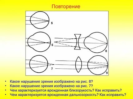 Осевая миопия