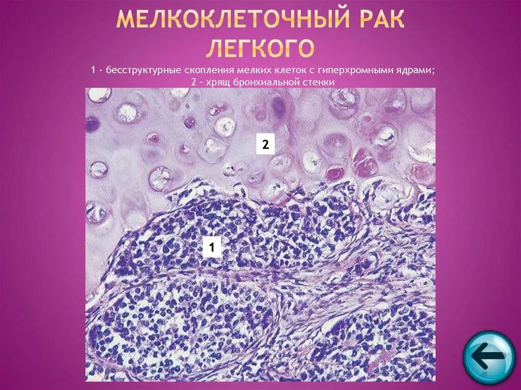 Гистологические варианты рака легкого. Мелкоклеточный ракмлегкого. опухоль легкого гистология. мелкоклеточная карцинома легкого гистология.