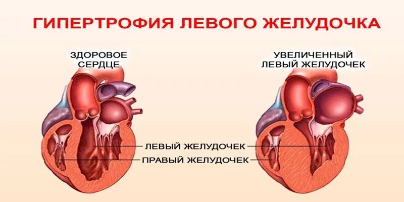 Гипертрофия что это. Гипертрофия левого желудочка. Гипертрофия мышцы сердца. Гипертрофия желудочка сердца. Компенсаторная гипертрофия сердца.