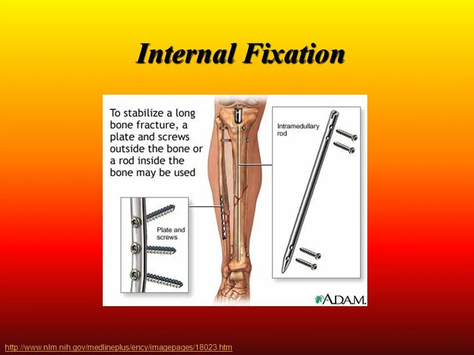 Internal download. External Fixators in Case of Fracture.