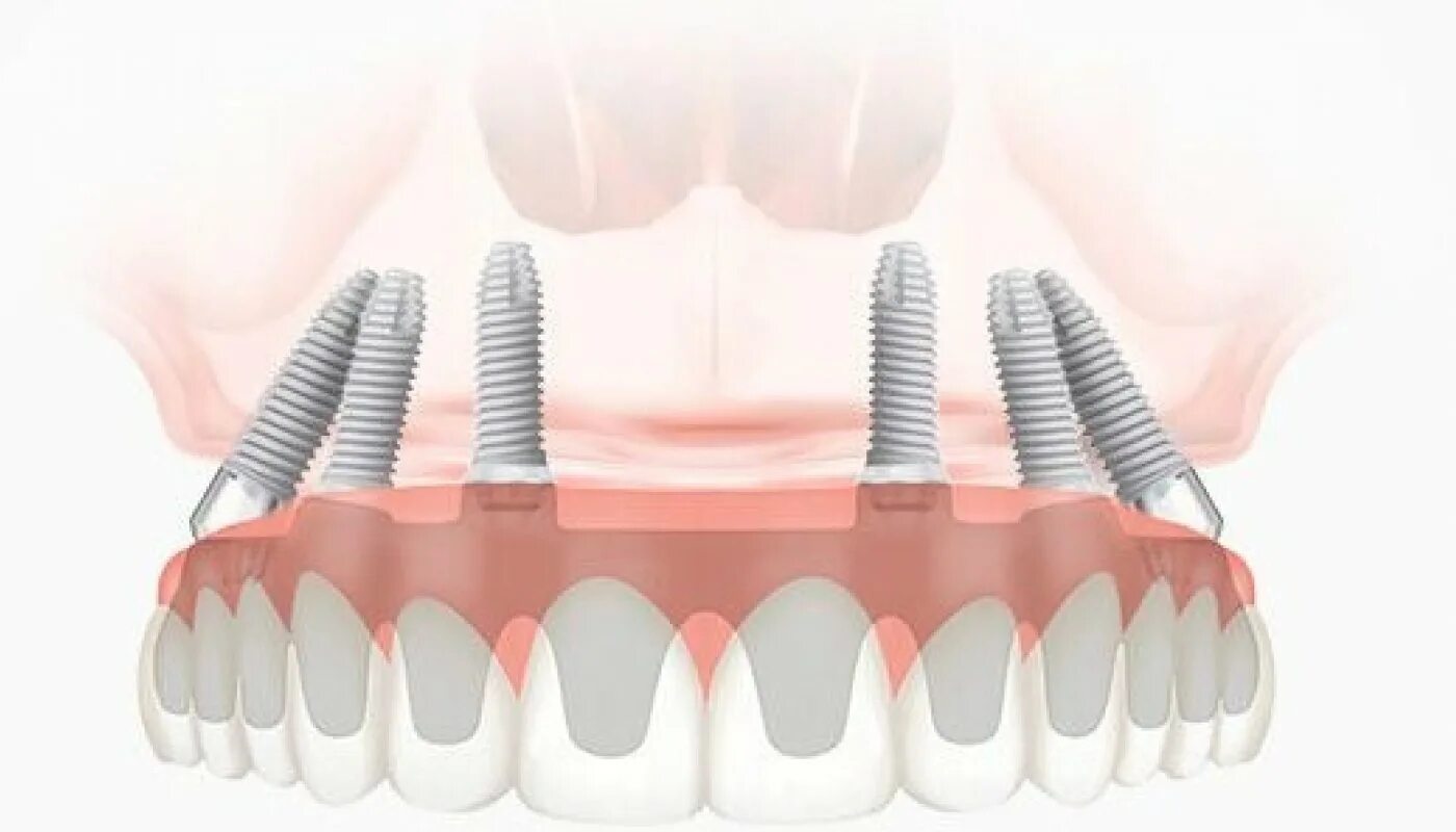 Имплантация зубов all on 6. (Метод имплантации all-on-4)методы. Имплантация челюсти на 6 имплантах. All in 6имплантах трансинусально.