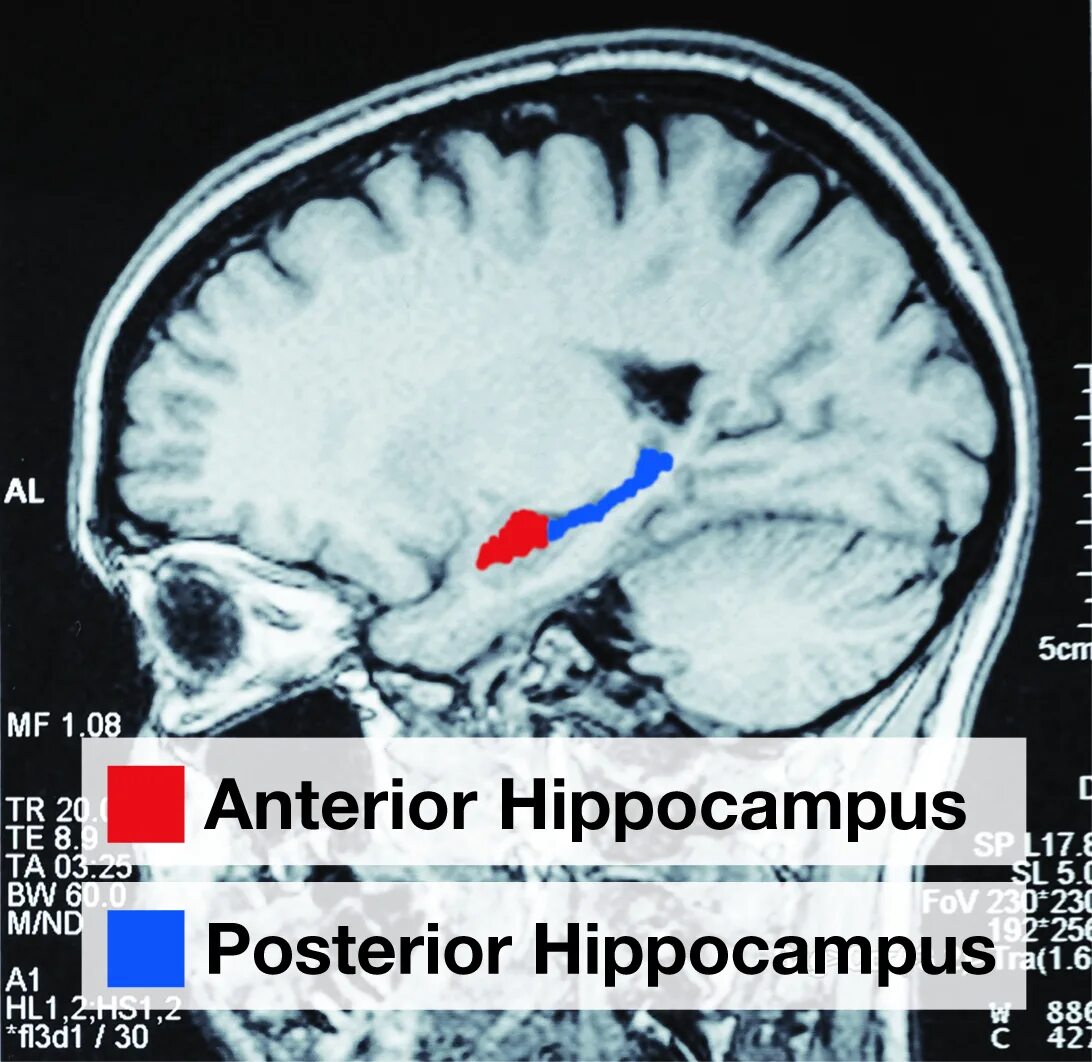 Повреждение гиппокампа. Гиппокамп. Гиппокампус мозга. Hippocampus. Симптомы поражения гиппокампа.