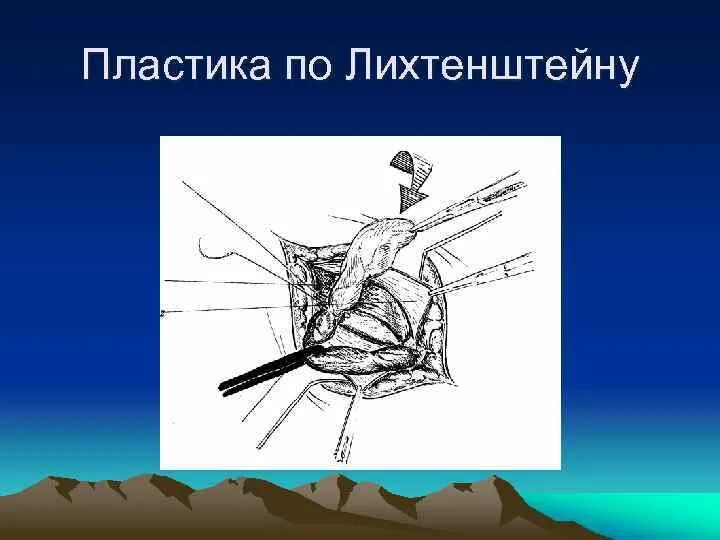 Пластика по Лихтенштейну. Пластика грыжи по Лихтенштейну. Операция по Лихтенштейну. Пластика брюшной стенки по Шампионеру. Лихтенштейн операция грыжа