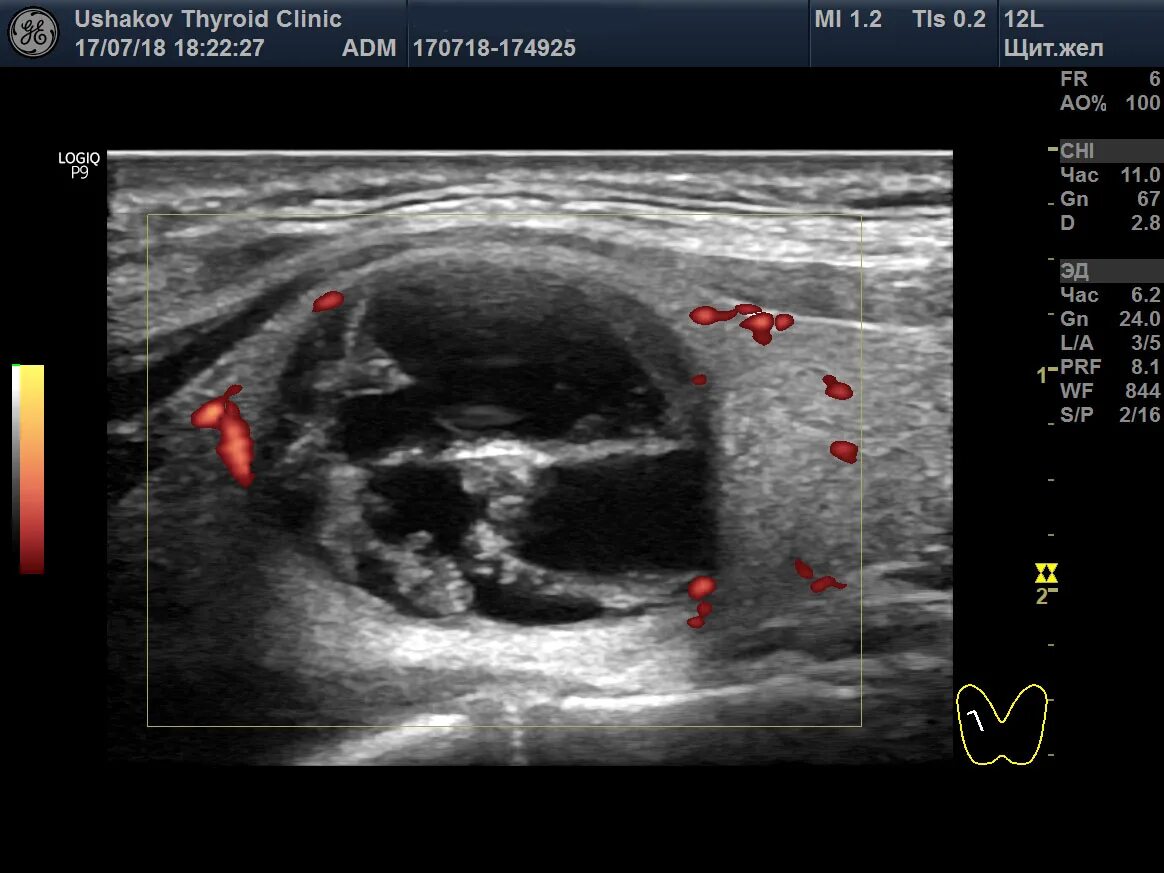 Узи аномалий. УЗИ щитовидной железы протокол Изранов. УЗИ щитовидной железы Изранов. УЗИ Изранов видеолекции. УЗИ протокол щит жел.