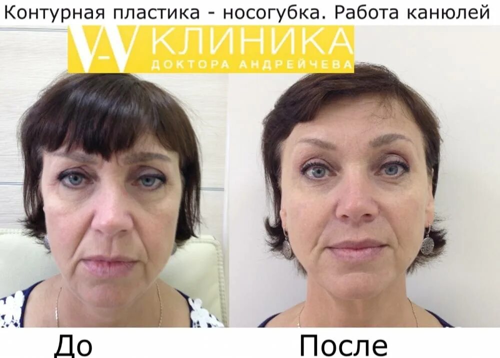 Контурная пластика лица skinlift. Канюли для контурной пластики на лице что это. Канюли в косметологии для лица. Контурная пластика канюлей. Канюли в косметологии для лица до и после.