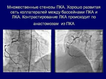 Стеноз пка