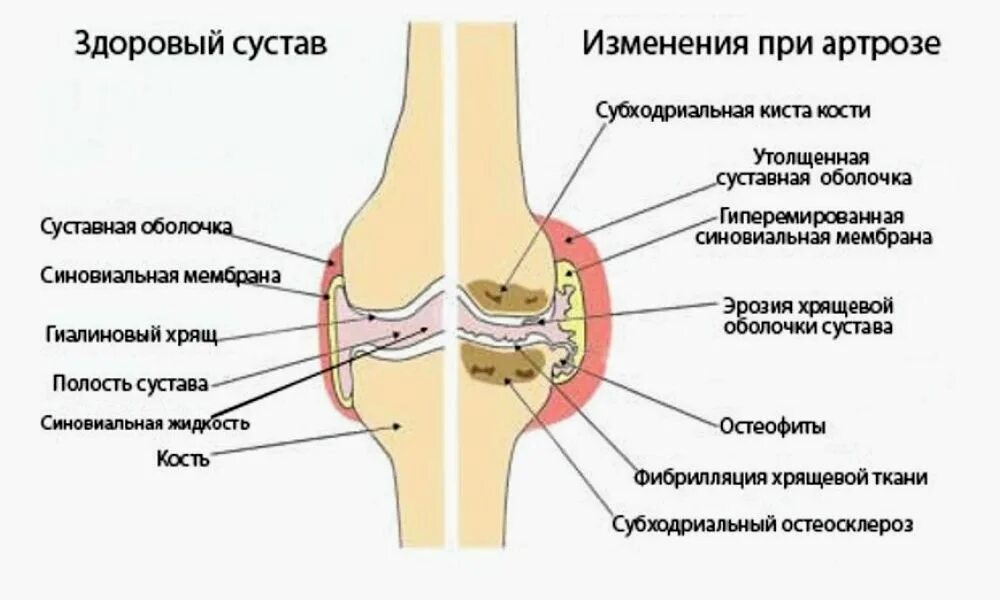 Хруст в коленях при сгибании и разгибании