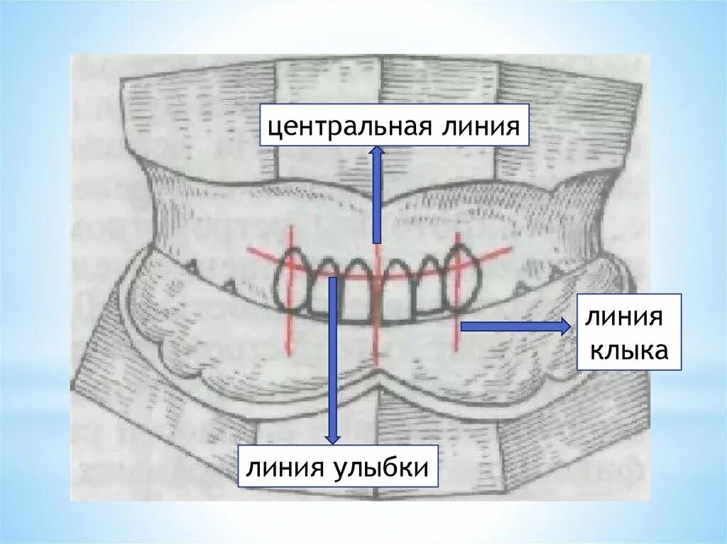Линия базиса. Линия Клыков. Линия улыбки. Определение центрального соотношения челюстей. Линии центрального соотношения челюстей.