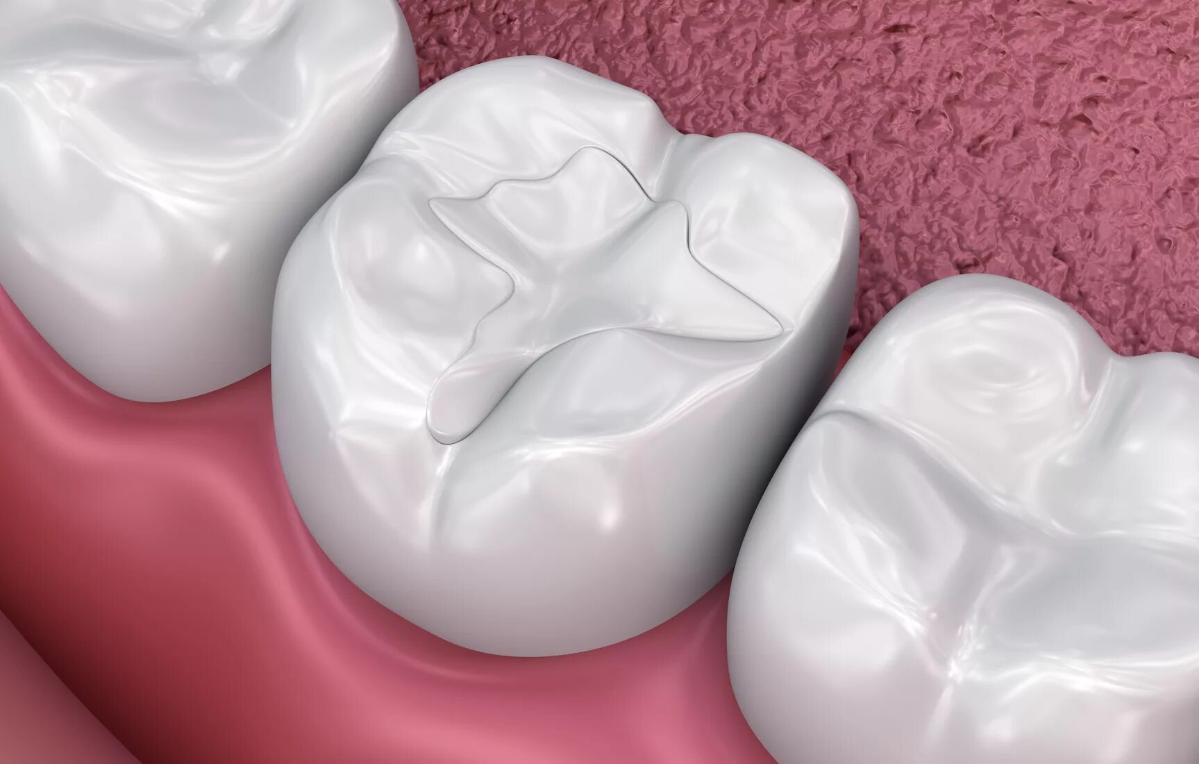 Tooth filling. Tooth filling