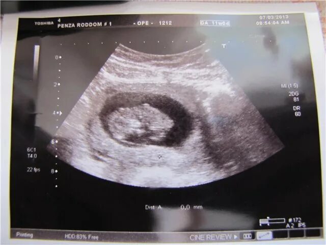 КТР 41 мм. КТР 11 недель. КТР эмбриона на 11 неделе. КТР 40 мм на 11 неделе.
