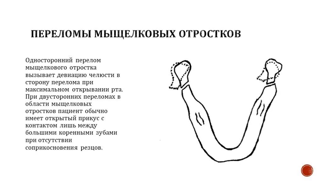 Перелом вывих мыщелкового отростка. Суставной отросток челюсти перелом. Суставной отросток челюсти перелом. Перелом суставного отростка челюсти. Перелом мыщелкового отростка нижней челюсти.