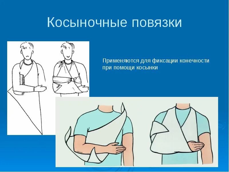 При каких ранениях применяется косыночная повязка. Косыночная повязка дезо. десмургия косыночная повязка. наложение косыночной повязки при переломе плеча. косыночная повязка на переломы.