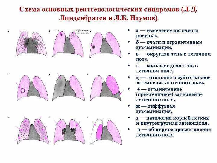 Основные рентгенологические синдромы заболеваний легких. Синдромы патологии легких на рентгене. 9 Основных синдромов поражения легких. Рентгенологические симптомы патологии легких. Рентгенологические синдромы легких