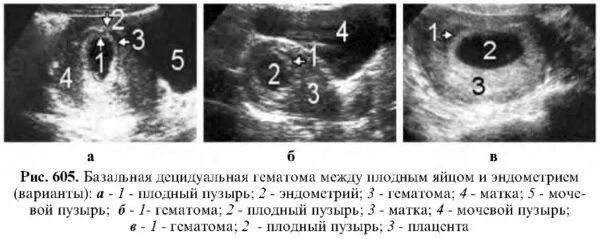 Отслойка оболочки плодного яйца. Отслойка плаценты на ранних сроках УЗИ. Отслойка на 6 неделе