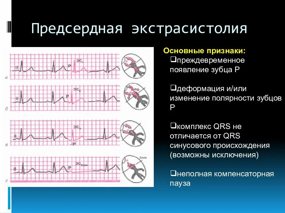 Экстрасистолия на ЭКГ. Предсердная экстрасистолия. Одиночные предсердные экстрасистолы. Для предсердной экстрасистолы характерно. Блокированные экстрасистолы