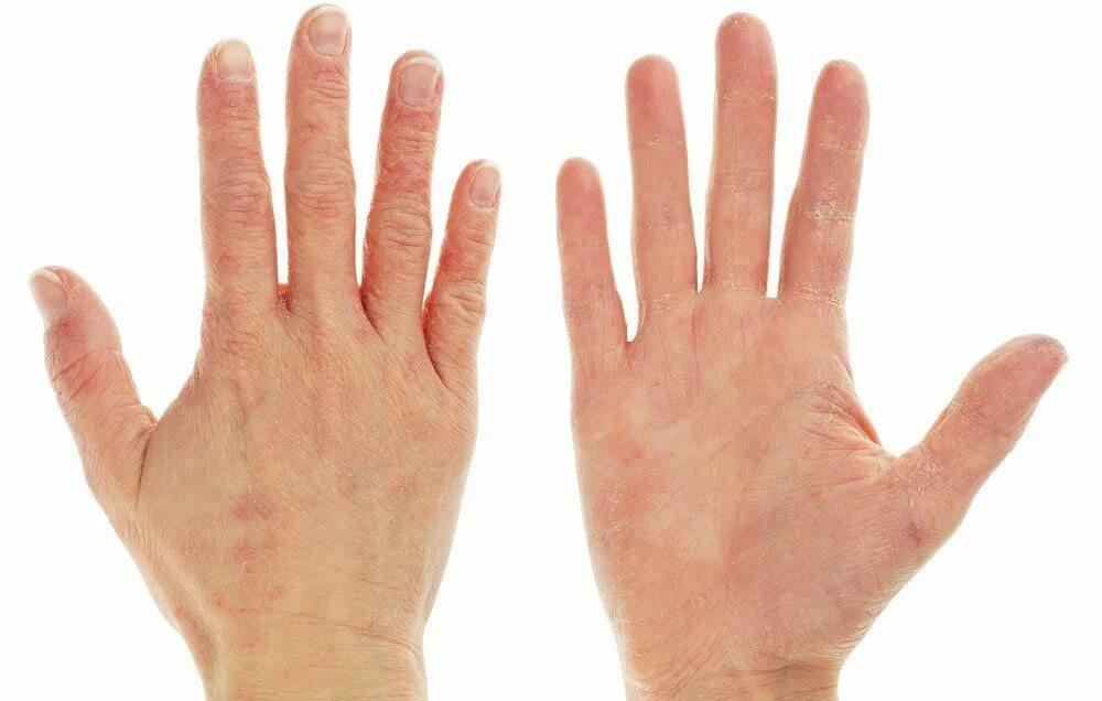 Онемение пальцев рук причины. Парестезия тройничного нерва. Немеют пальцы на руках причины. Женская рука. Кожа человека.