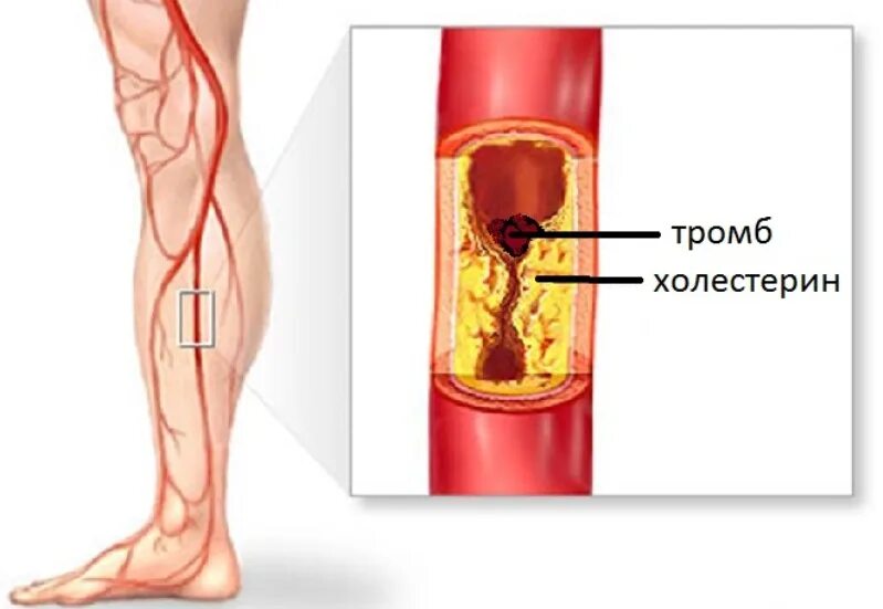 Что такое тромб и как он. Что такое тромб и как он