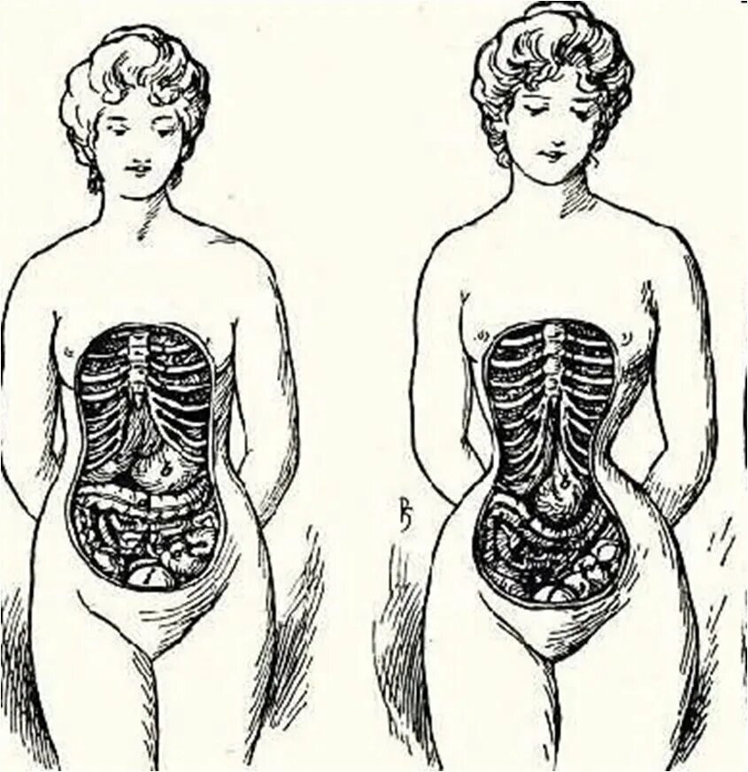 Люди с большим тазом. Корсет для талии 19 века органы. Ребра после корсета рентген. Последствия ношения корсета. Смещение органов в корсете.