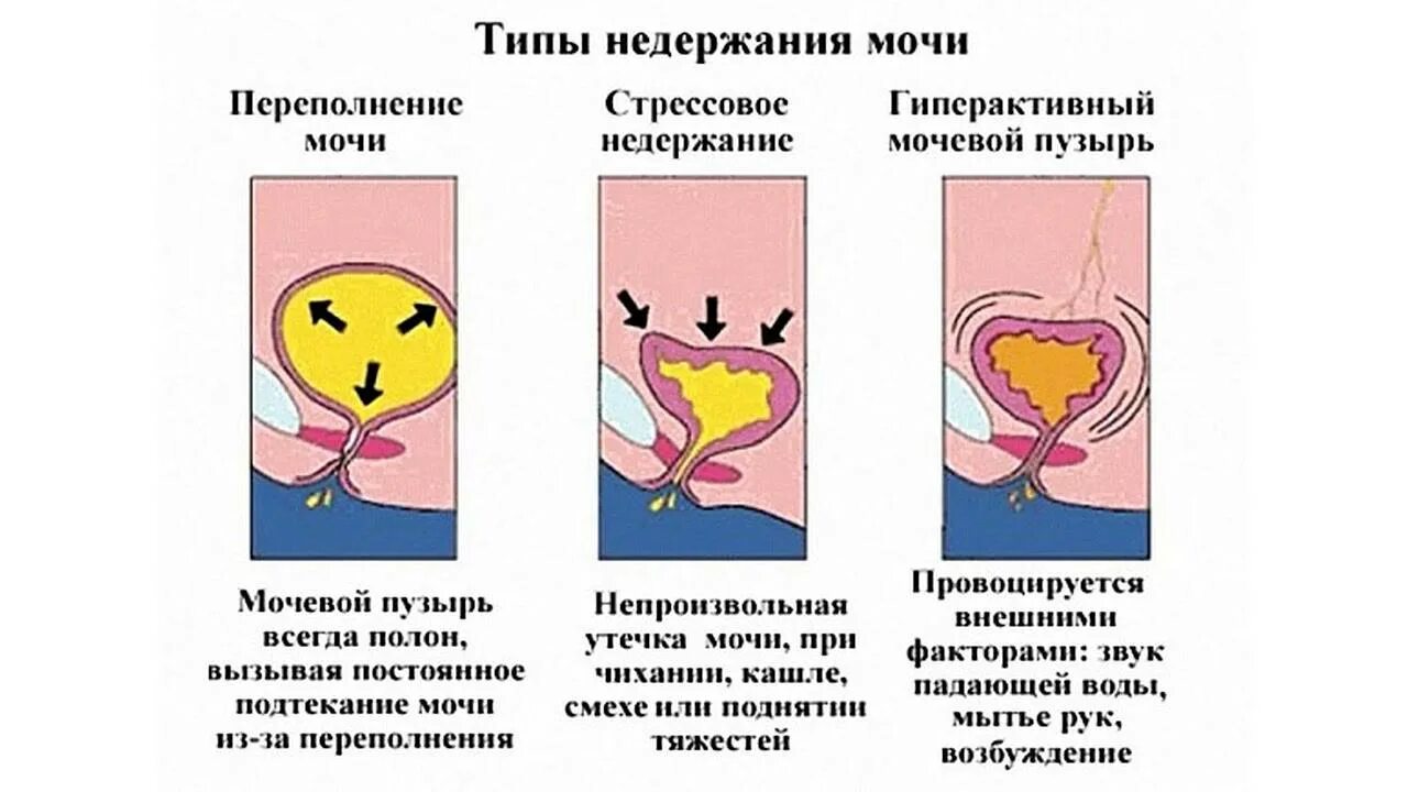 Выделяется моча у женщин. Мочевой пузырь недержание. недержание мочевого пузыря у женщин. ургентное недержание.