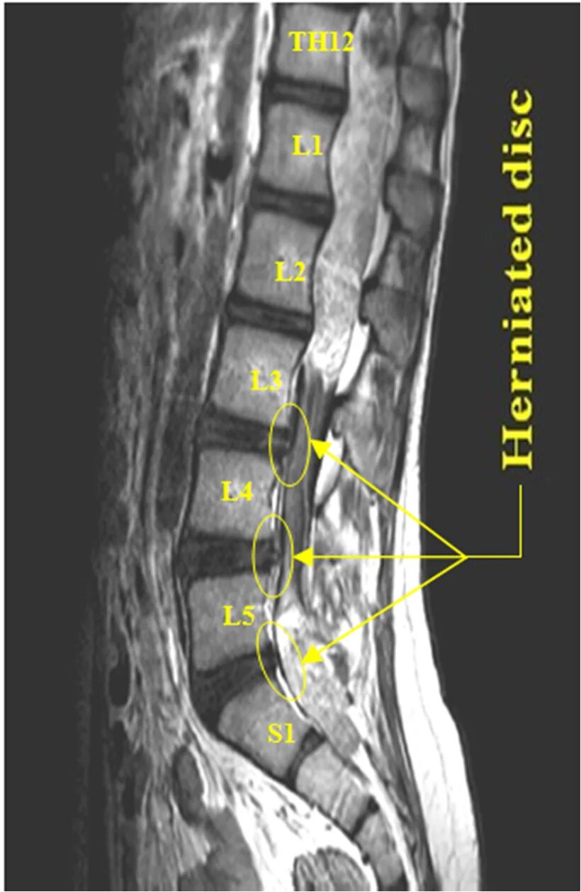 Грыжа диска l2-l3. Грыжа дисков l4-l5/s1. Протрузия диска l1 l2, l2-l3. Диски l3-s1.