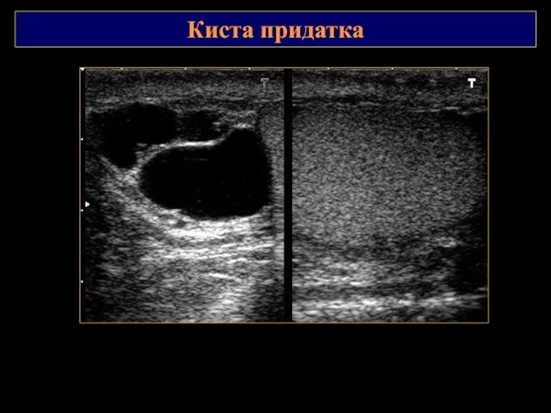 Киста головки у мужчин. Кисты семенного канатика УЗИ картина. Киста придатка яичка на УЗИ. Киста семенного канатика на УЗИ. Киста головки придатка левого яичка УЗИ.