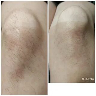 Электроэпиляция это больно