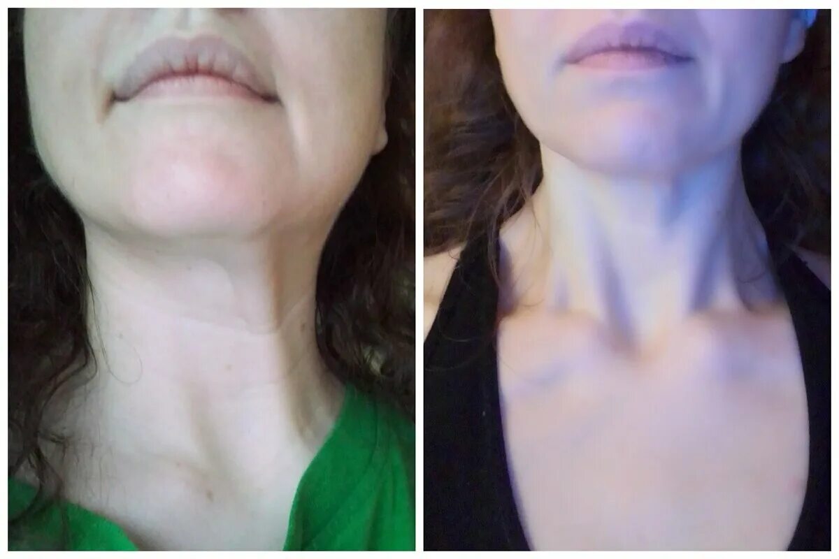 Можно ли удалить шей. Вдовий горбик липосакция. Подтяжка подбородка. Упражнения от вдовьего горба. Вдовий горбик холка липома.