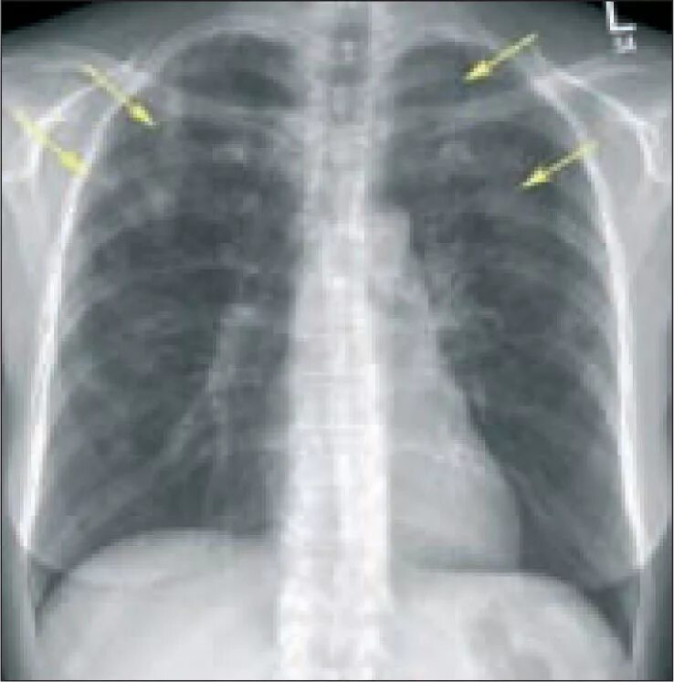 Аскаридоз рентген легких синдром леффлера. Эозинофильный инфильтрат легкого рентген. Эозинофильный инфильтрат легкого рентген. Эозинофильная инфильтрация легких кт. Эозинофильный инфильтрат.