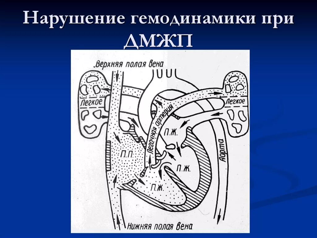 Дефект межжелудочковой перегородки у детей гемодинамика. Гемодинамика при дефекте межжелудочковой перегородки. Дефект межжелудочковой перегородки гемодинамика схема. Гемодинамика у детей