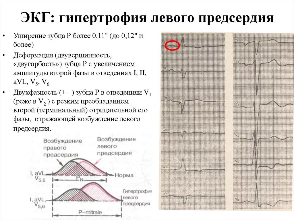 Признаки гипертрофии левого предсердия на ЭКГ. Гипертрофия левого предсердия на ЭКГ. Гипертрофия левого предсердия и правого желудочка на ЭКГ. ЭКГ при гипертрофии левого и правого предсердия. Гипертрофия левого предсердия левого желудочка