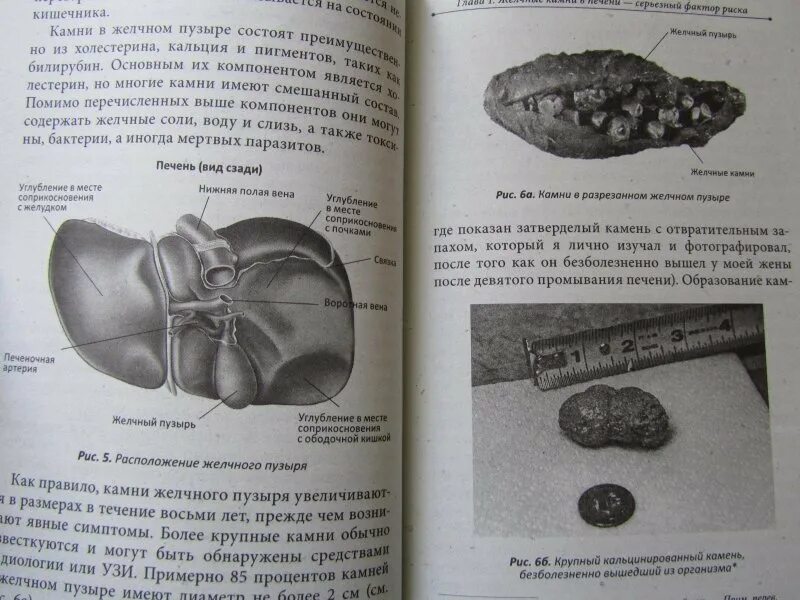 Удалили желчный пузырь что можно есть. Камни в удаленном желчном пузыре. Диета при камнях в желчном пузыре. Камень в жёлчном пузыре диеиа.