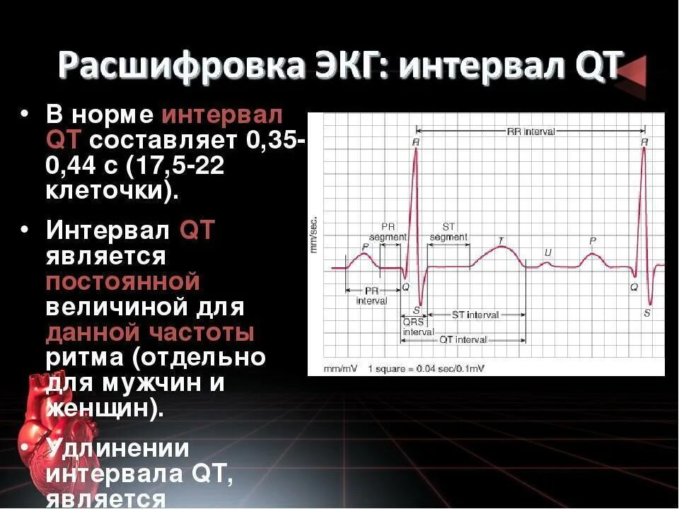 Норма qt у детей. Интервал qt на экг норма. нормальный интервал qt на экг норма. кардиограмма интервал qt норма. qt и qtc на экг норма.