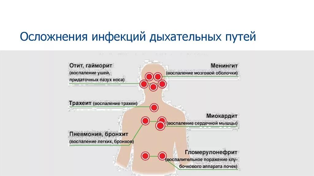 Осложнения при вирусных инфекциях. Инфекции дыхательных путей. Острые респираторные вирусные инфекции верхних дыхательных путей. Осложнения ОРЗ. Осложнения коронавирусной инфекции