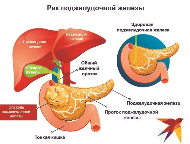 4 стадия поджелудочной железы сколько живут. Опухоль поджелудочной железы. Онкология поджелудочной железы. Головка поджелудочной железы. Раковая опухоль поджелудочной железы.