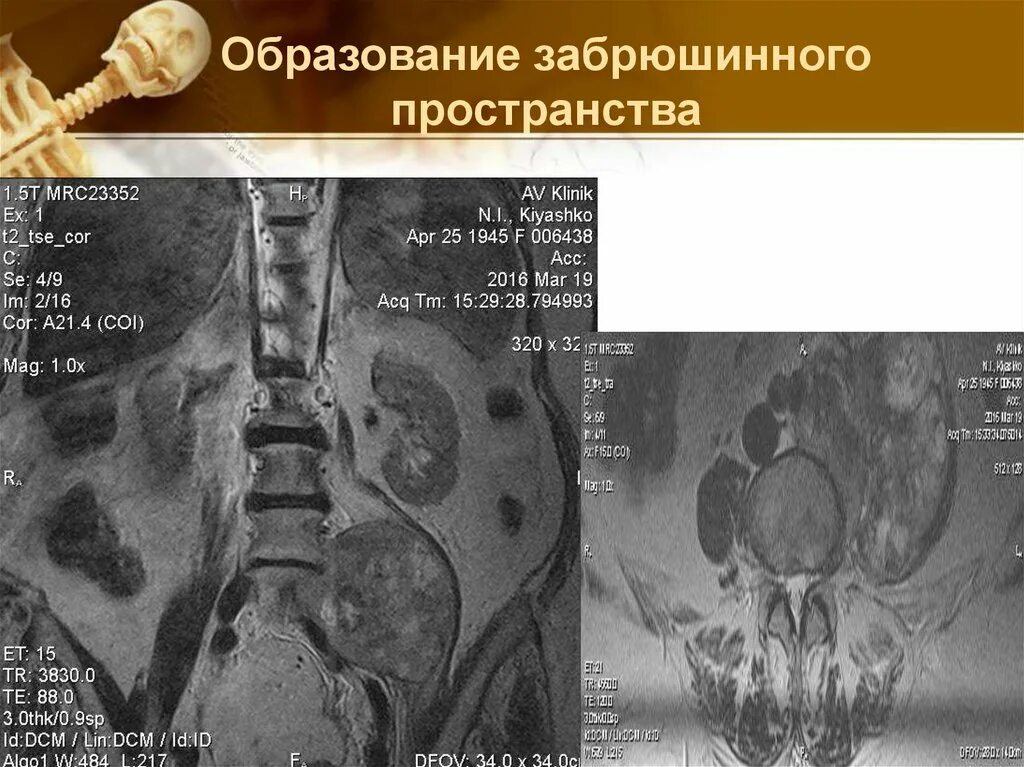 Забрюшинная онкология