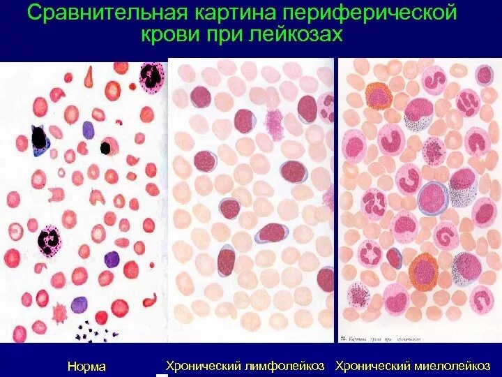 Острый лейкоз мазок крови. Острый миелобластный лейкоз мазок. Хронический лейкоз мазок крови. Картина крови хронического миелолейкоза. Кровь при лимфолейкозе