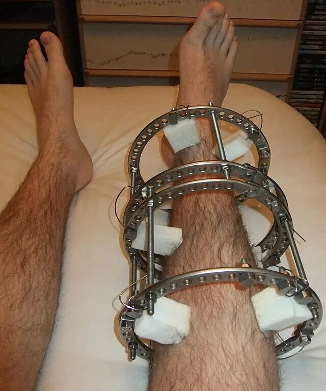 External fixation - Wikipedia
