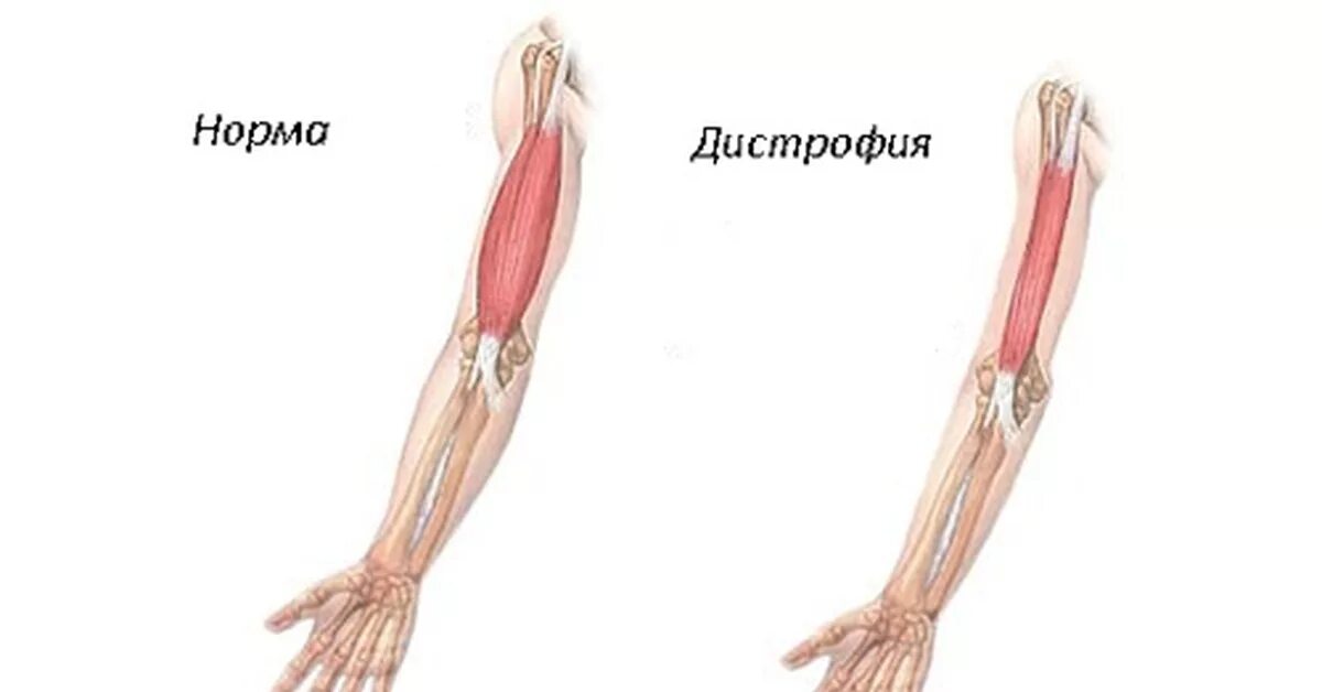 Мышечная атрофия мышц