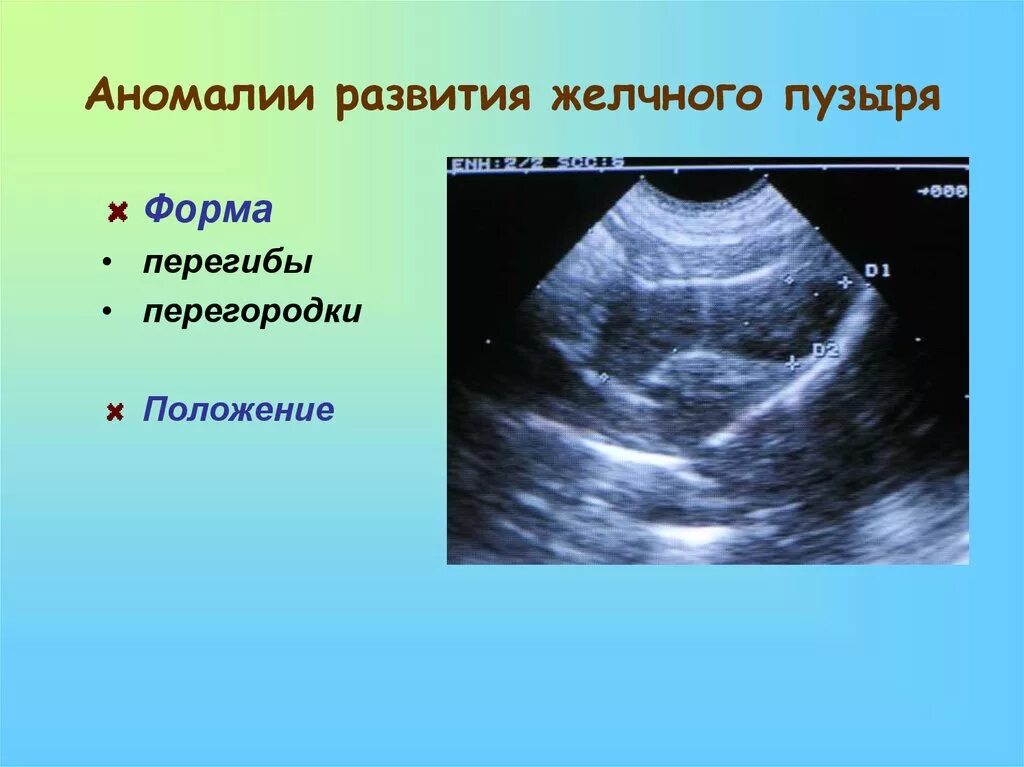 Желчный пузырь неправильной формы. Врожденный перегородка желчного пузыря. Аномалии развития желчного пузыря. Аномалия формы желчного пузыря. Аномалии развития желчного пузыря на УЗИ.