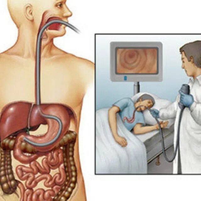 Пищевод какой врач. Двенадцатиперстная кишка ФГДС. Гастроскопия (ЭГДС, ФГДС). Эндоскопическое исследование пищевода желудка и 12-перстной. Гастроскопия желудка гастрит.