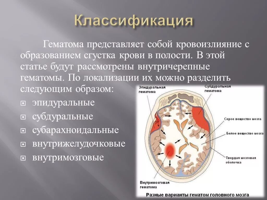 Гематома черепно мозговой травме. Эпидуральная гематома классификация. Субдуральные гематомы классификация. Локализация гематом в мозговом отделе головы. Субдуральная гематома локализация.